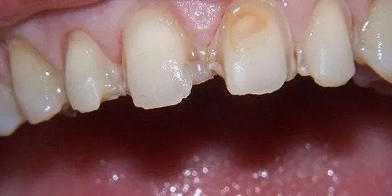 Veneers case before