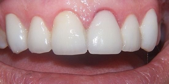 Veneers case after