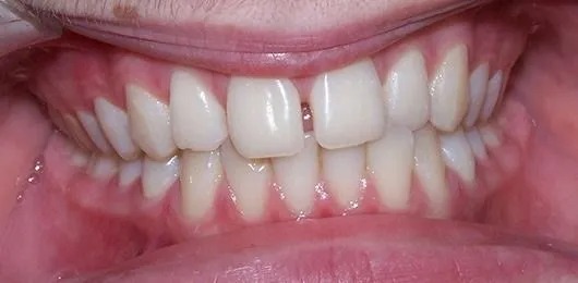 Braces case before