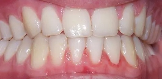 Braces case after